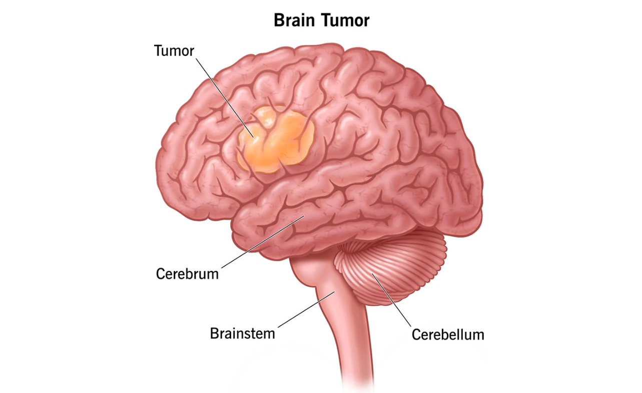 How Do I Know If I Have a Brain Tumor Common Warning Signs – ICD ...