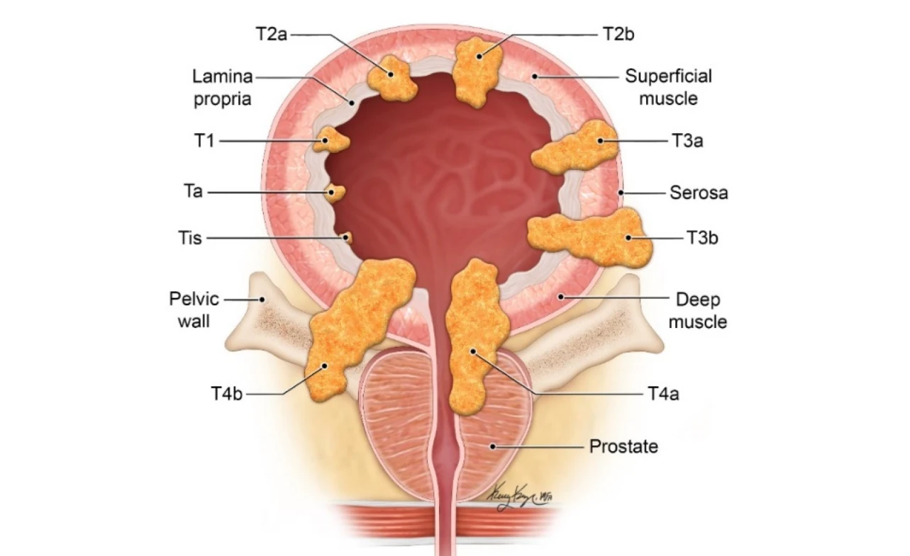 ICD-10 Code for Bladder Cancer