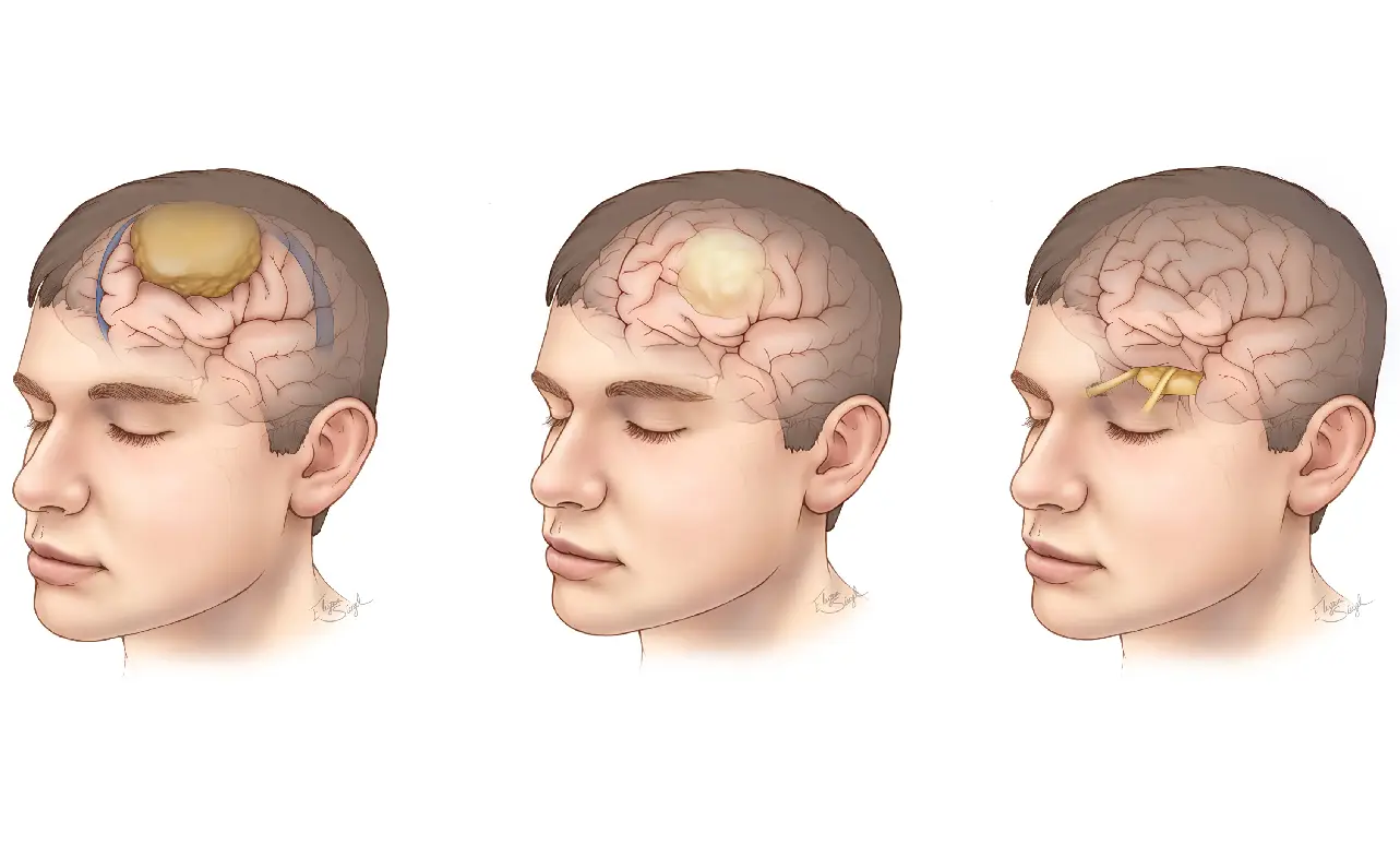 ICD-10 Code for Brain Cancer