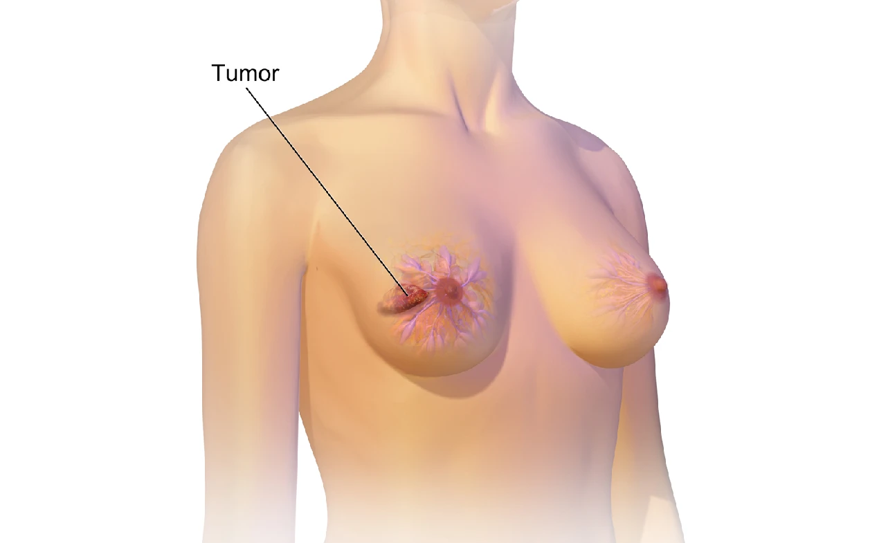 ICD 10 Code for Breast Cancer