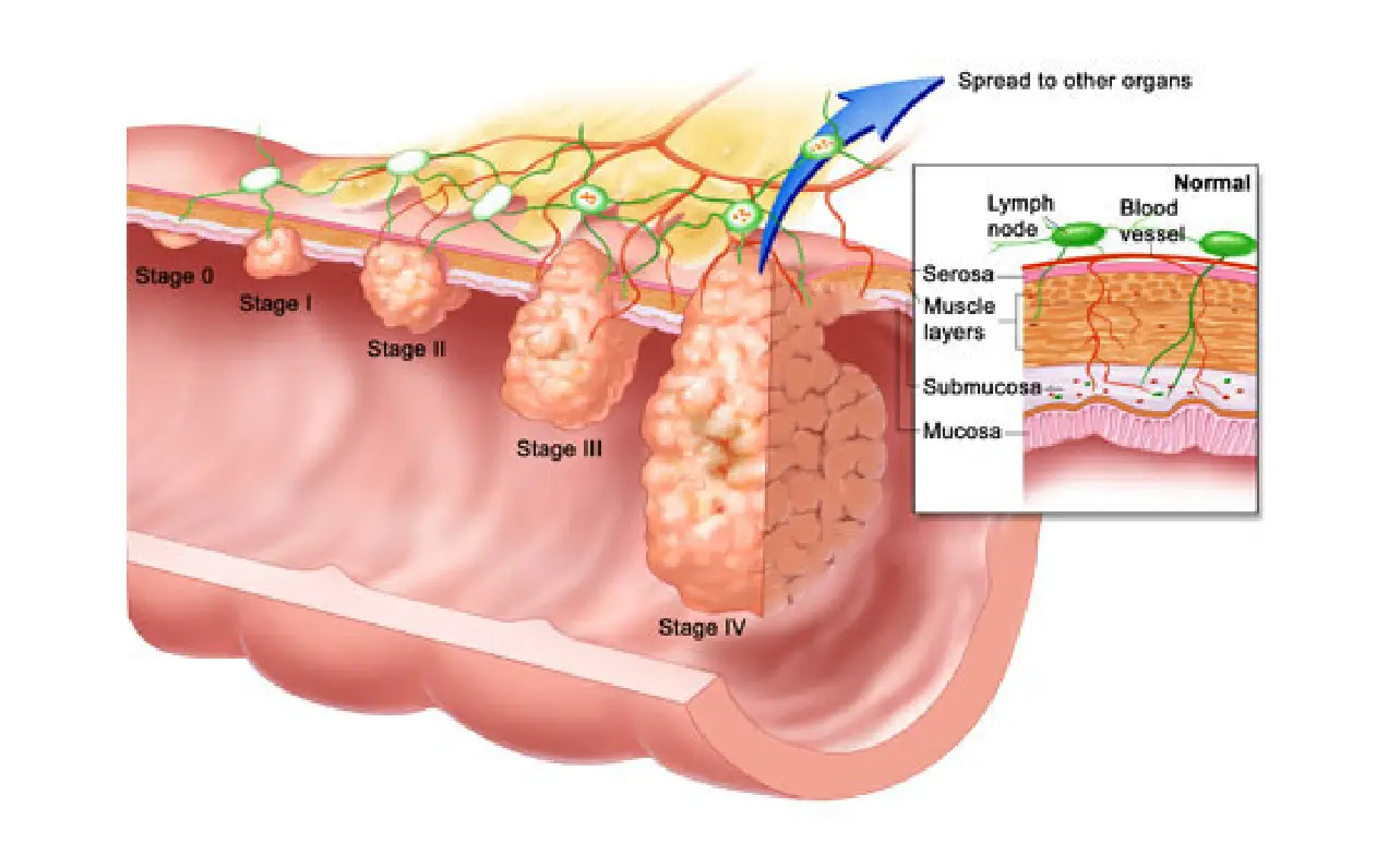 ICD-10 Code for Colon Cancer Screening