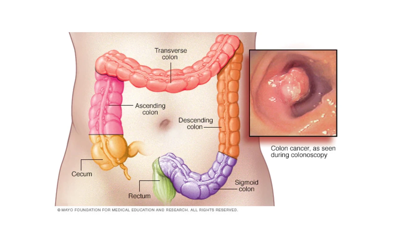 ICD 10 Code for Colon Cancer