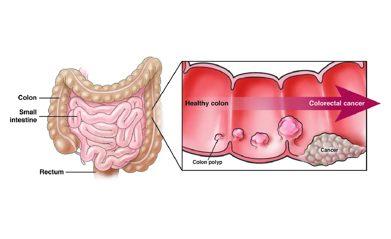 ICD-10 Code for Colorectal Cancer