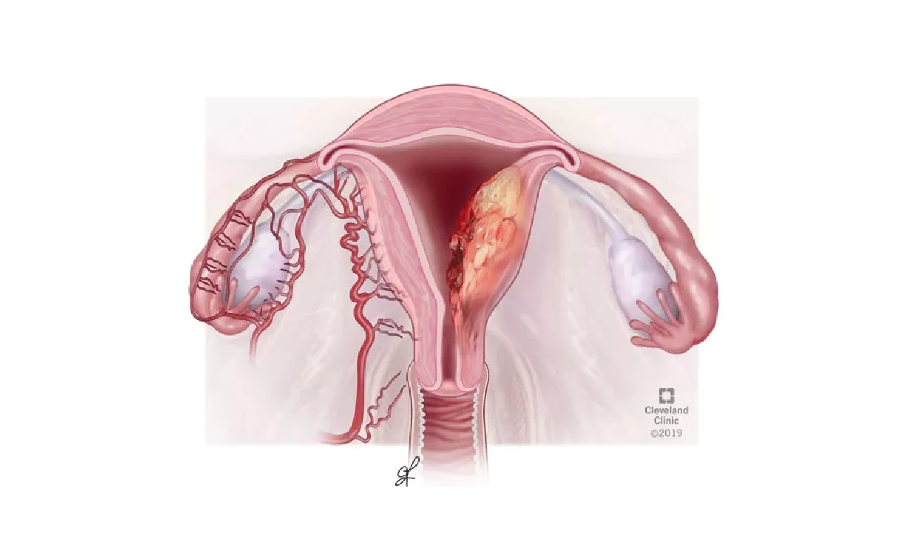 ICD 10 Code for Endometrial Cancer