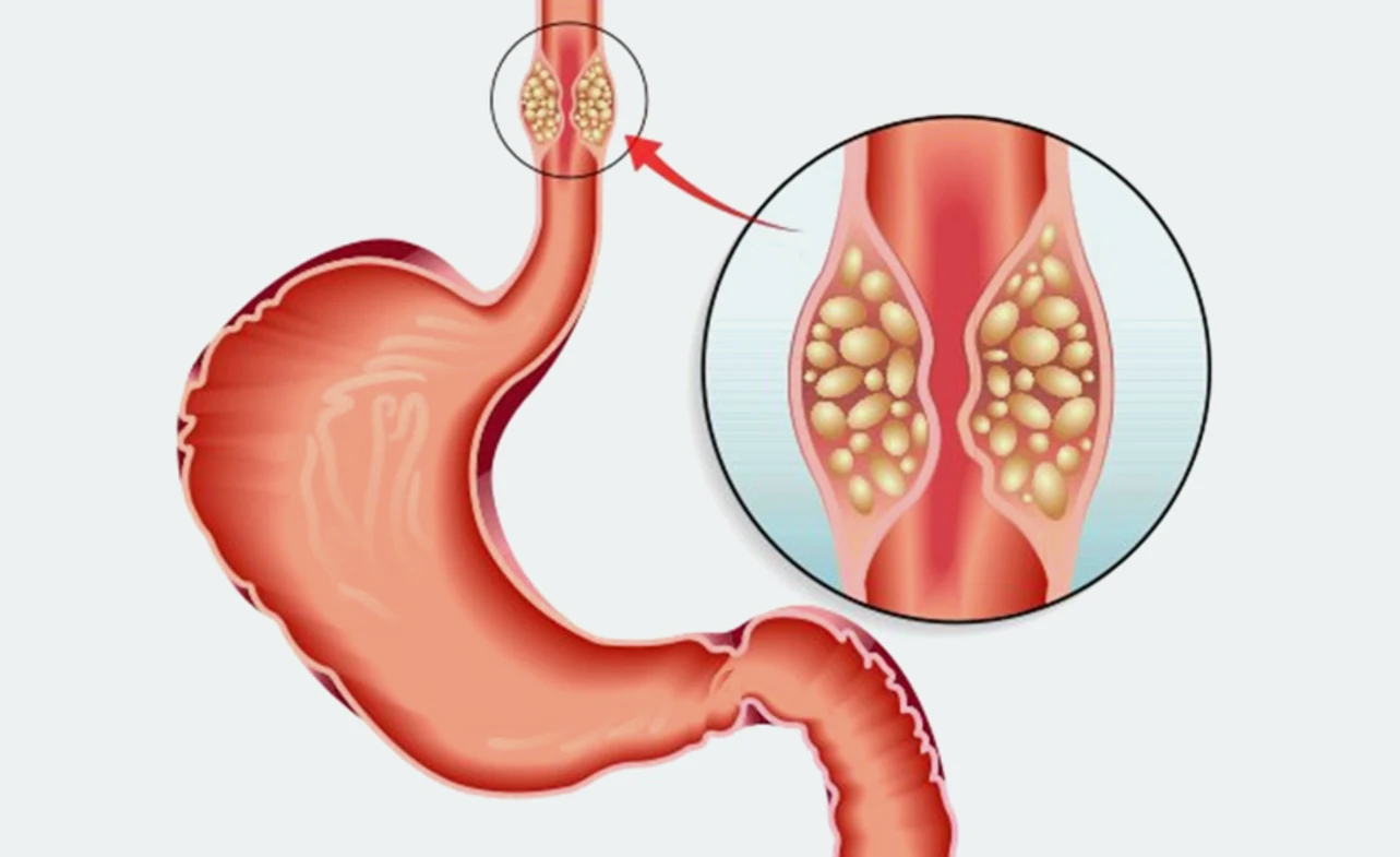 ICD 10 Code for Esophageal Cancer