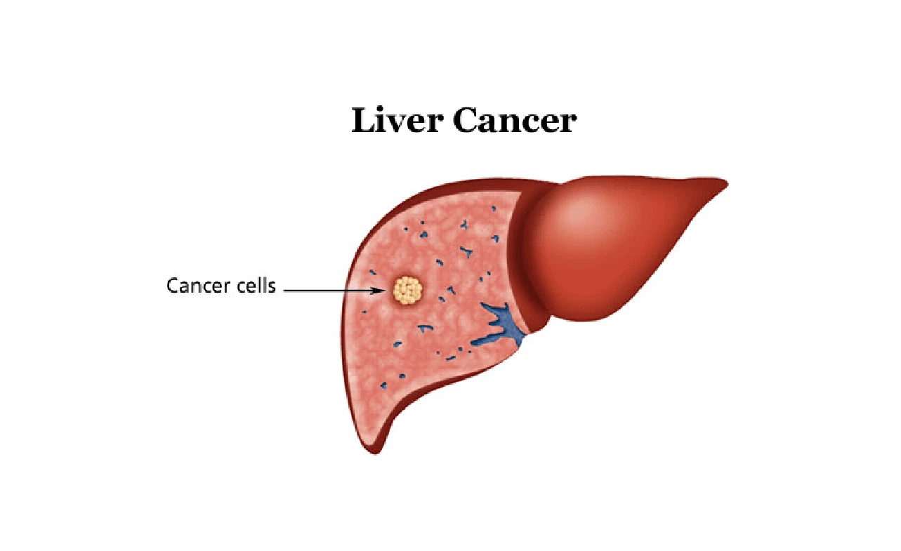 ICD-10 Code for Liver Cancer