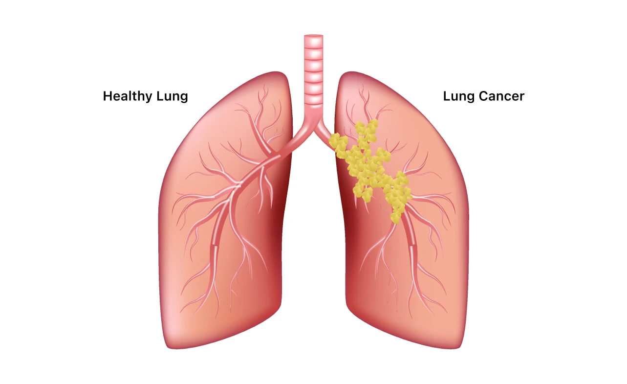 ICD 10 Code for Lung Cancer