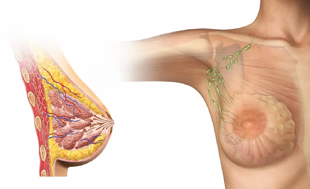 ICD-10 Code for Metastatic Breast Cancer