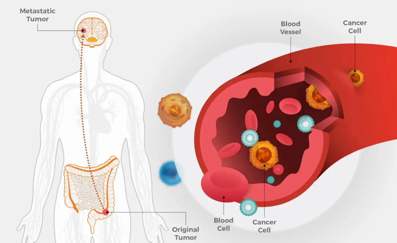 ICD 10 Code for Metastatic Colon Cancer