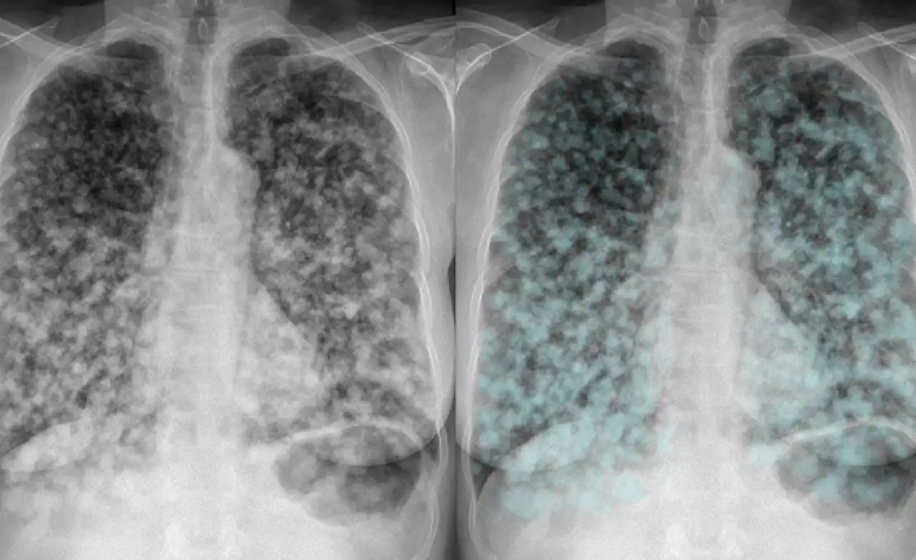 ICD 10 Code for Metastatic Lung Cancer