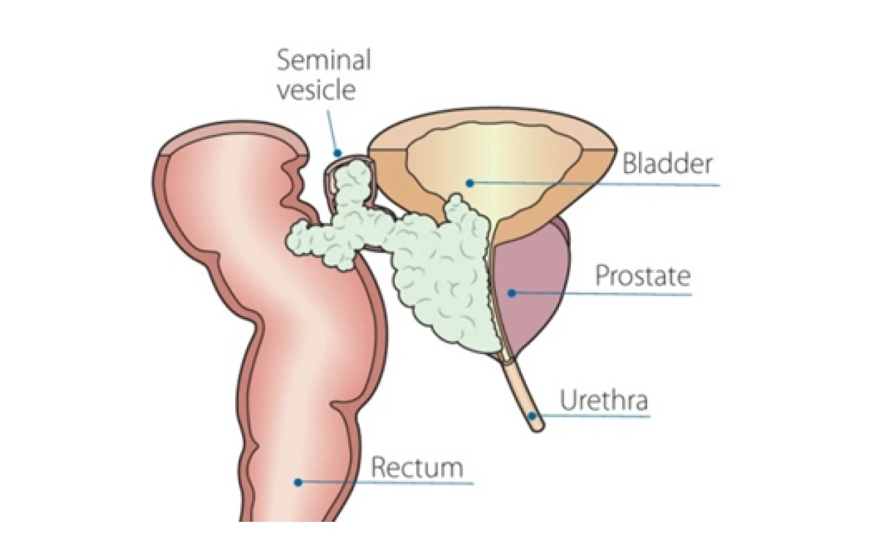 ICD 10 Code for Metastatic Prostate Cancer