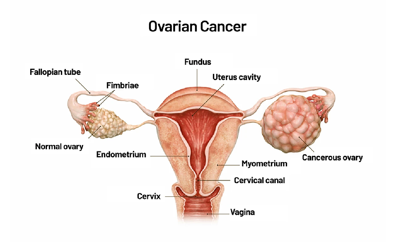 ICD 10 Code for Ovarian Cancer