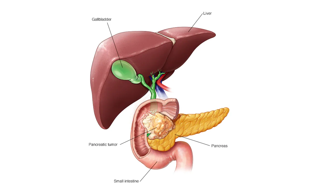 ICD 10 Code for Pancreatic Cancer