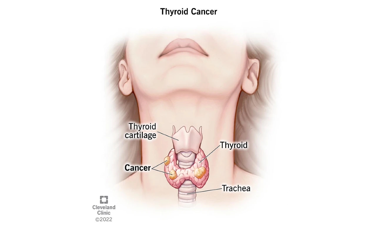 ICD-10 Code for Thyroid Cancer