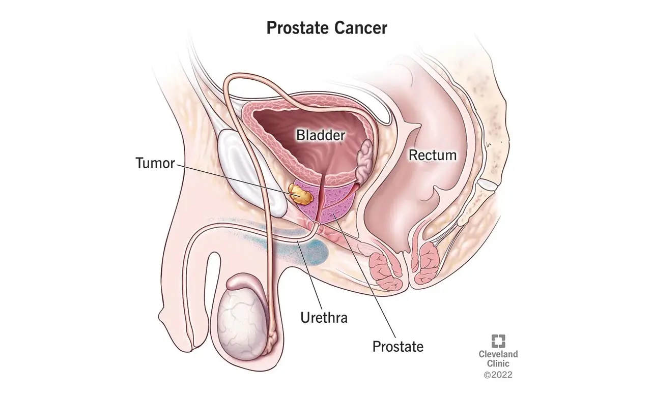 ICD-10 code for prostate cancer