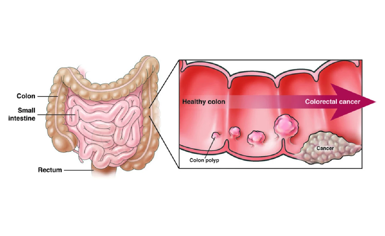 icd 10 code for colorectal cancer