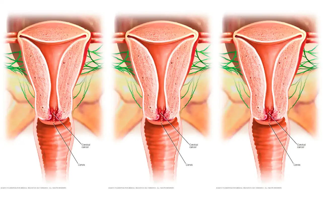 ICD-10 Code for Cervical Cancer