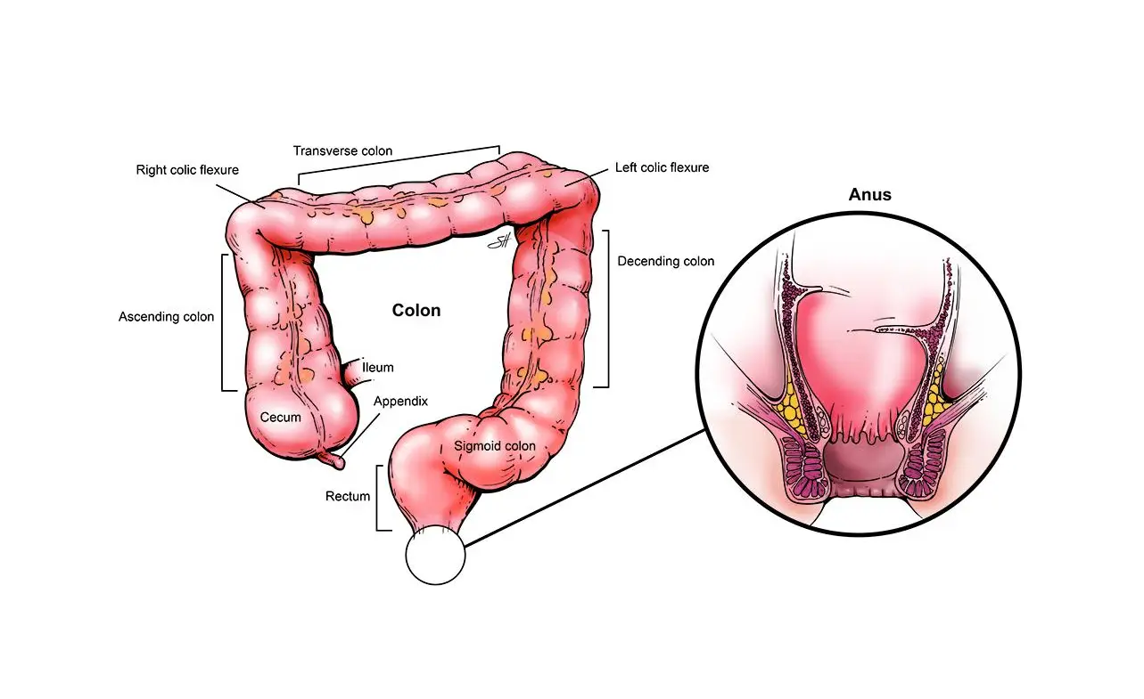 ICD-10 Code for History of Colon Cancer