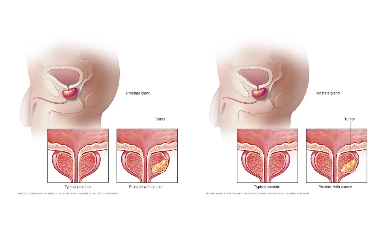 ICD-10 Code for History of Prostate Cancer