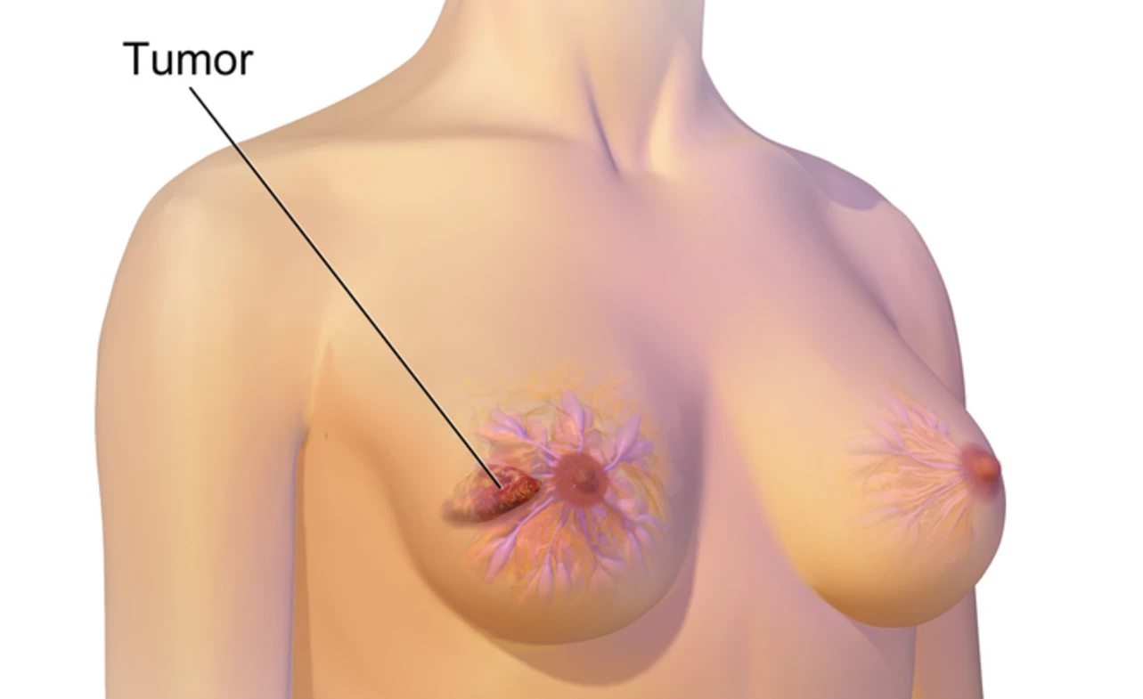 ICD-10 Code for Left Breast Cancer