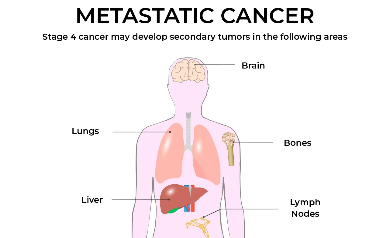 ICD-10 Code for Metastatic Cancer