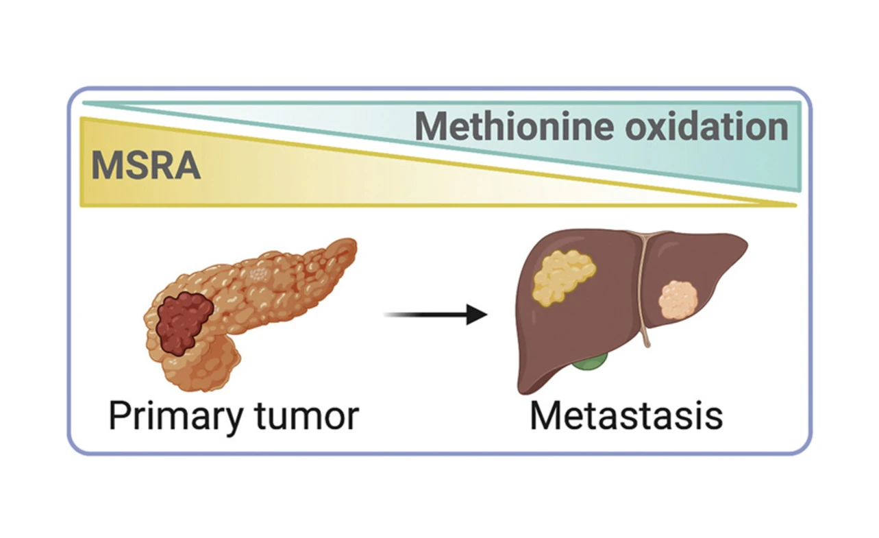 ICD-10 Code for Metastatic Pancreatic Cancer